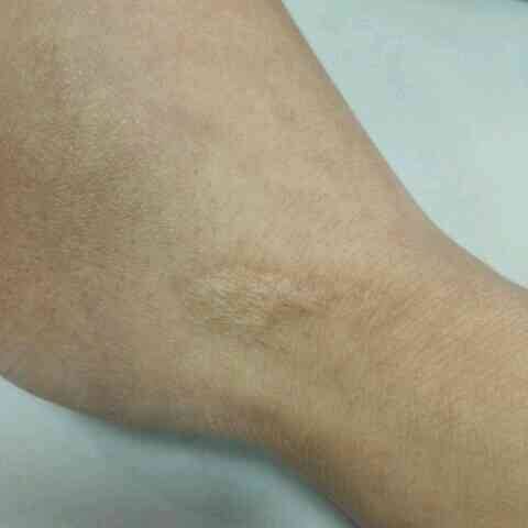 骑摩托车留下的疤痕，远不止是皮肤上的印记