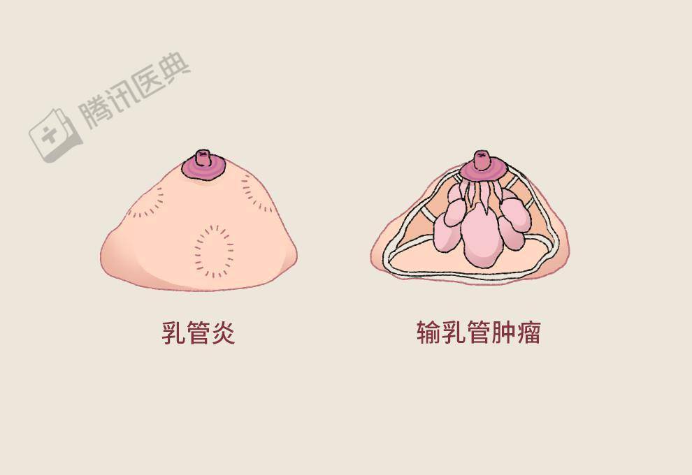 健康的乳晕是什么样子/难看的乳晕图片女